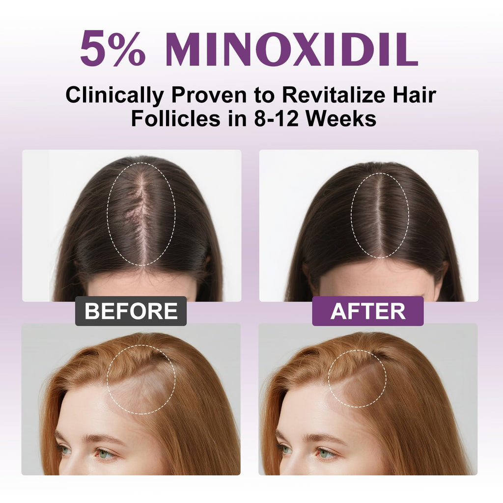 EZBIORT 5% Minoxidil Spray for Women – 4‑Pack, Biotin-Infused Hair Regrowth, 13oz (7 Month Supply)