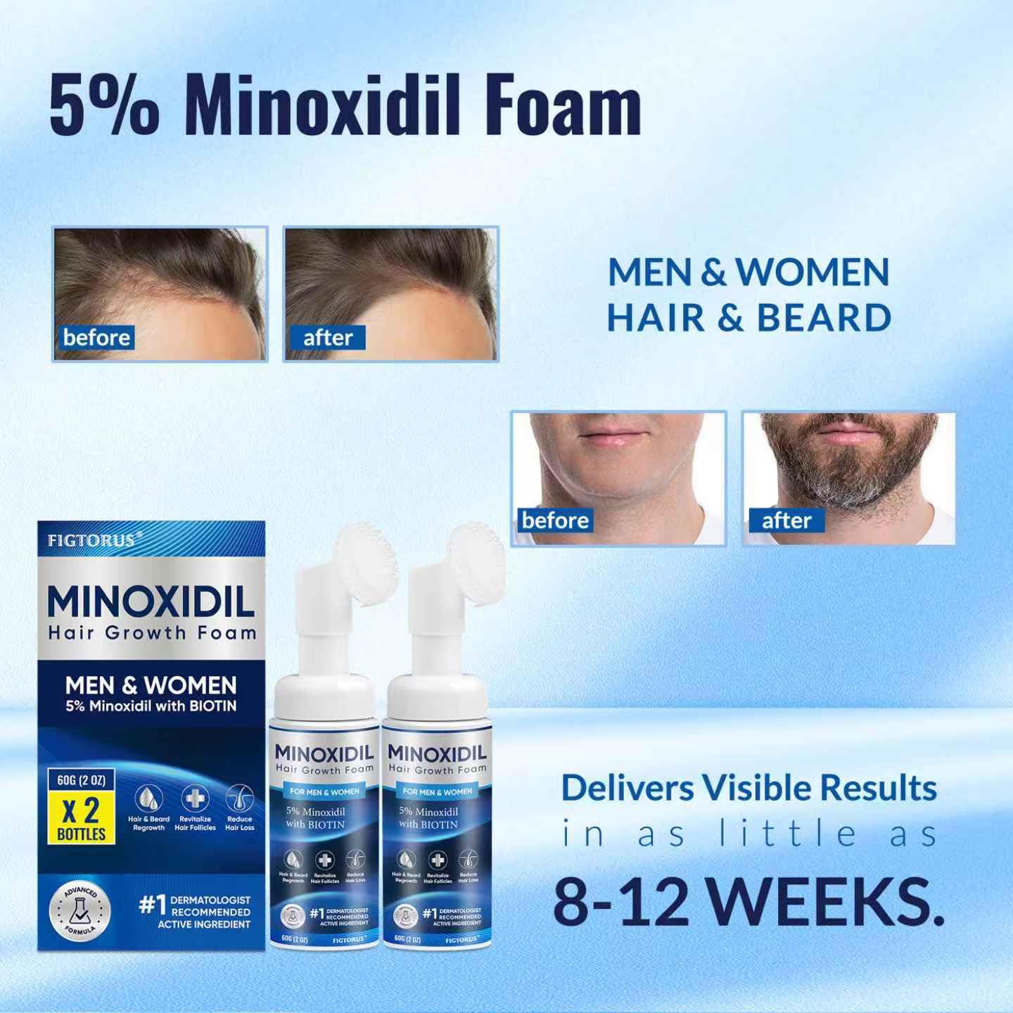 FIGTORUS 5% Minoxidil Foam for Men and Women – Hair Growth Support (4 oz)