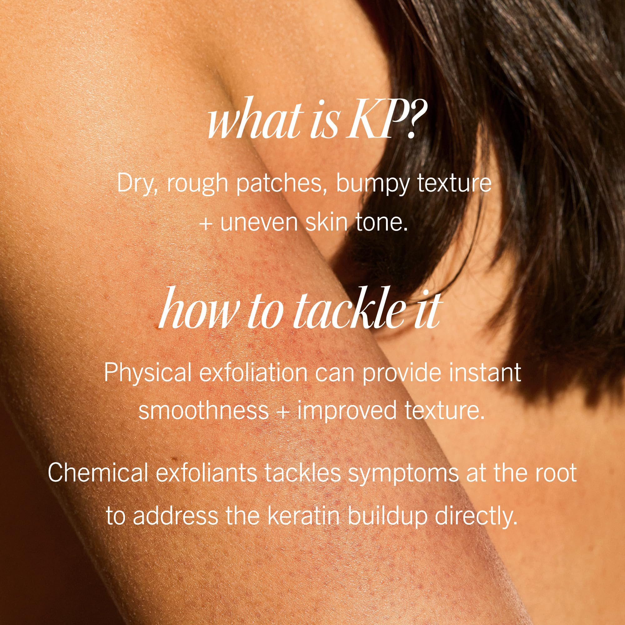 First Aid Beauty KP Bump Eraser Body Scrub — 10% AHA with Glycolic & Lactic Acids, 2 oz, 3 ct