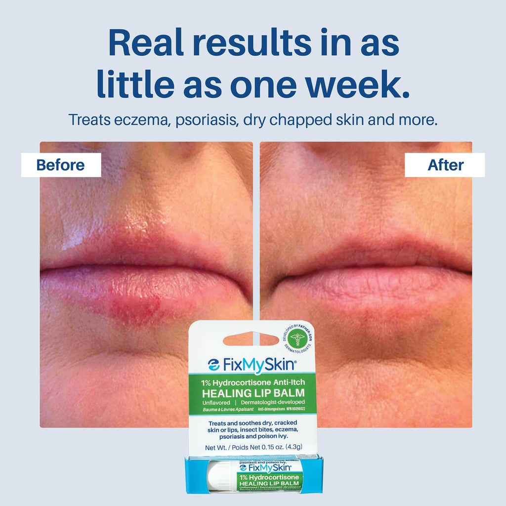 FixMySkin 1% Hydrocortisone Healing Lip Balm, Unflavored – 0.15 oz