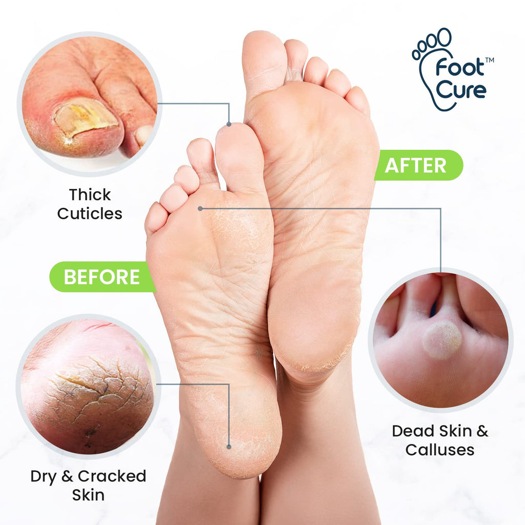 Foot Cure Tea Tree Foot Soak & Callus Remover Gel Kit — Extra Strength Pedicure for Tired Feet