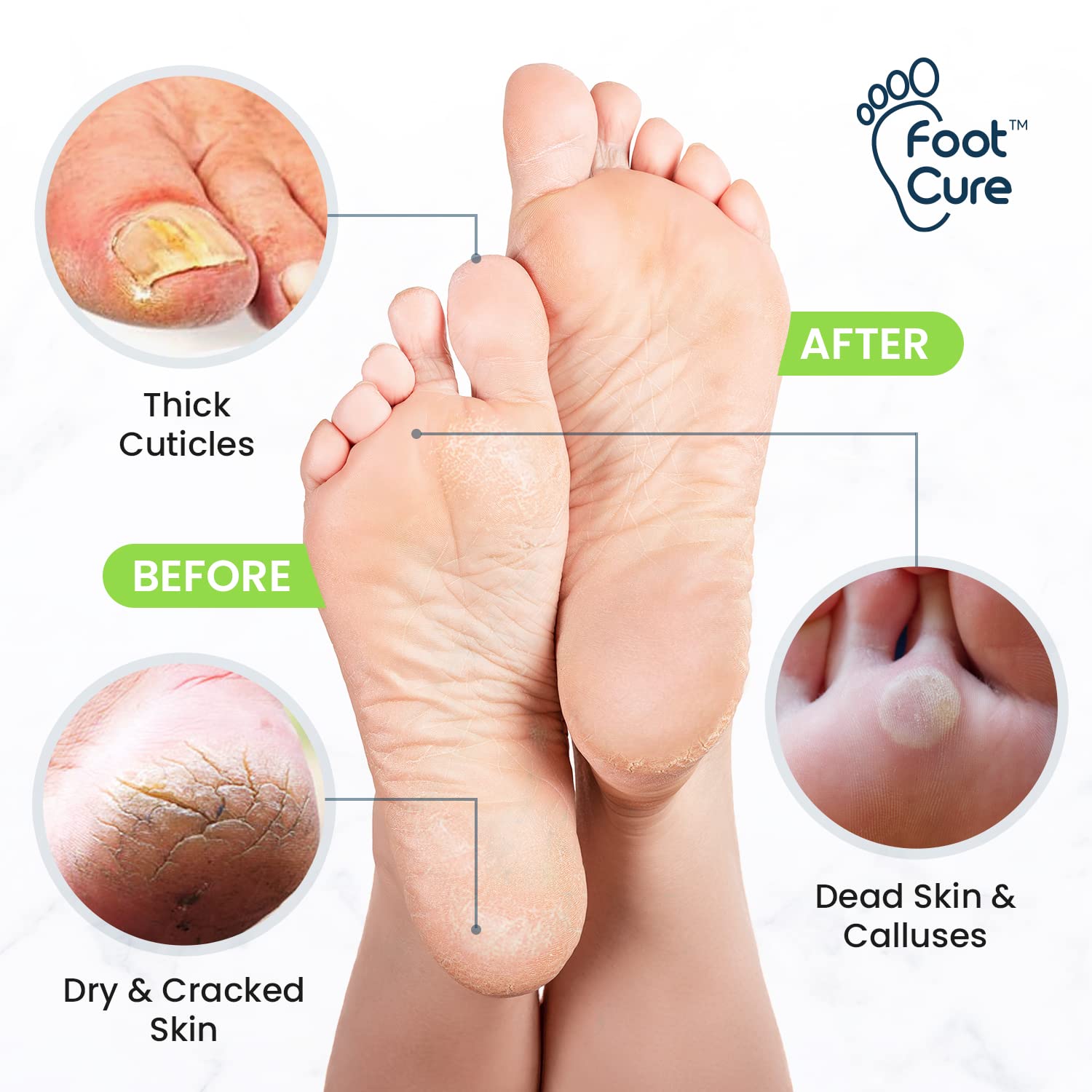 Foot Cure Tea Tree Foot Soak & Callus Remover Gel Kit — Extra Strength Pedicure for Tired Feet