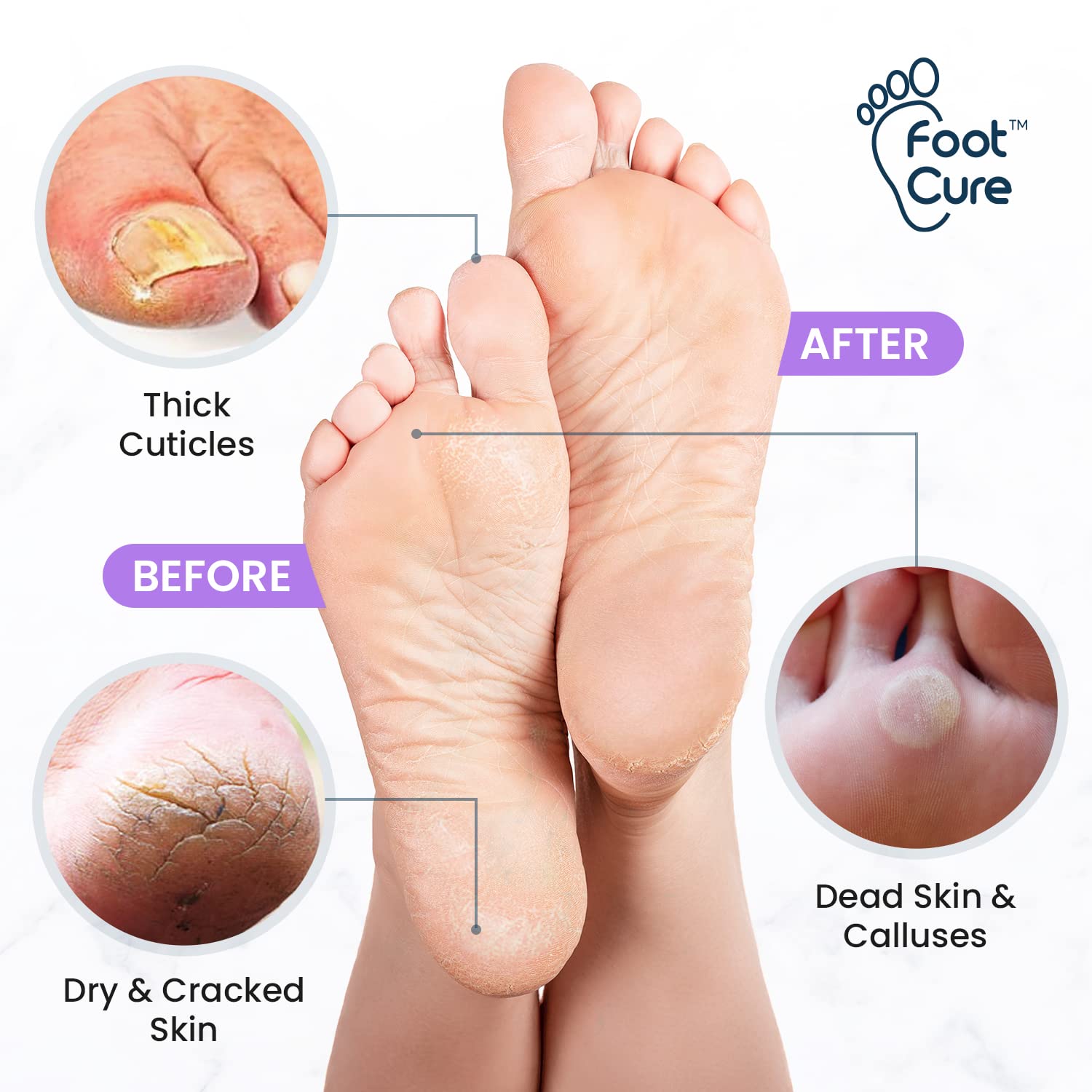 FOOT CURE Lavender Foot Soak & Callus Remover Gel Kit | Extra-Strength Foot Care for At-Home Pedicures