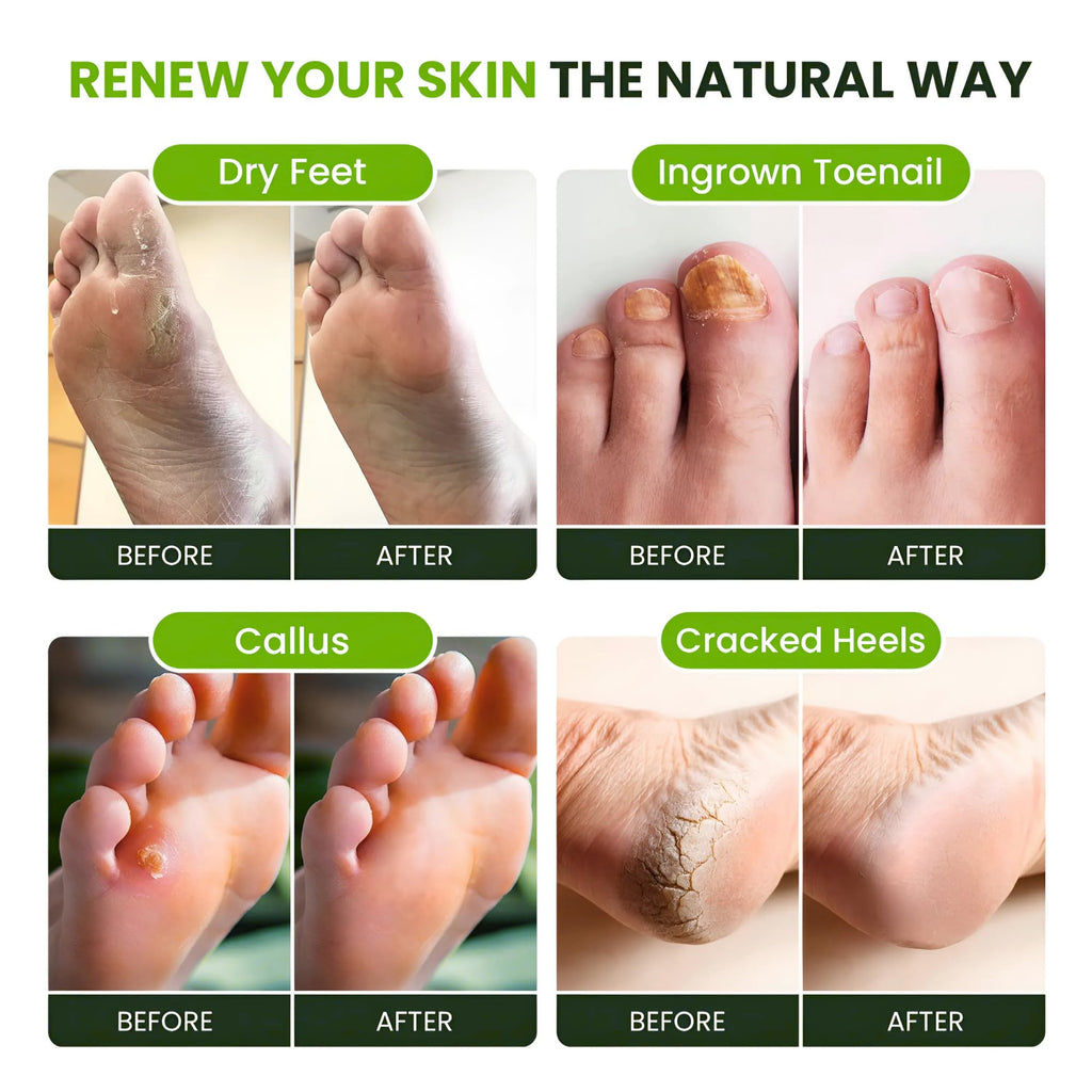 FOOT CURE Tea Tree Oil Foot Soak with Epsom Salt | Soothes Feet, Softens Calluses, Odor Control | Made in USA 16 oz