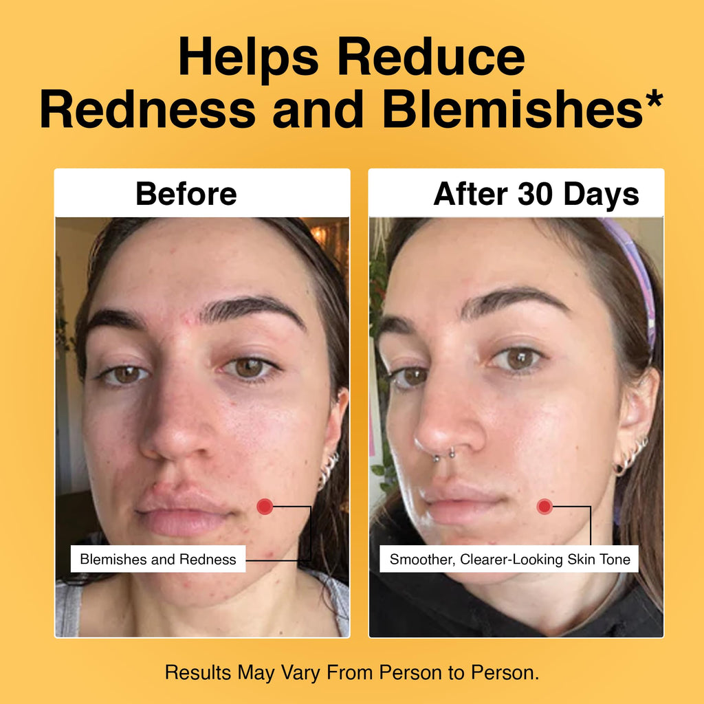 Foundation Skincare Azelaic Acid 14% for Face – Dermatologist Formula for Uneven Skin Tone (1 oz)