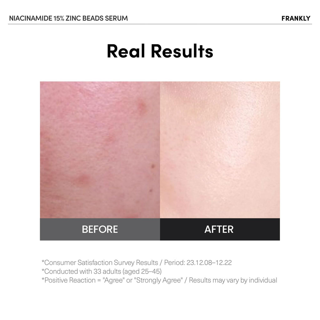 FRANKLY Niacinamide 15% + Zinc Bead Serum | Gentle, Oil-Balancing Skin Support