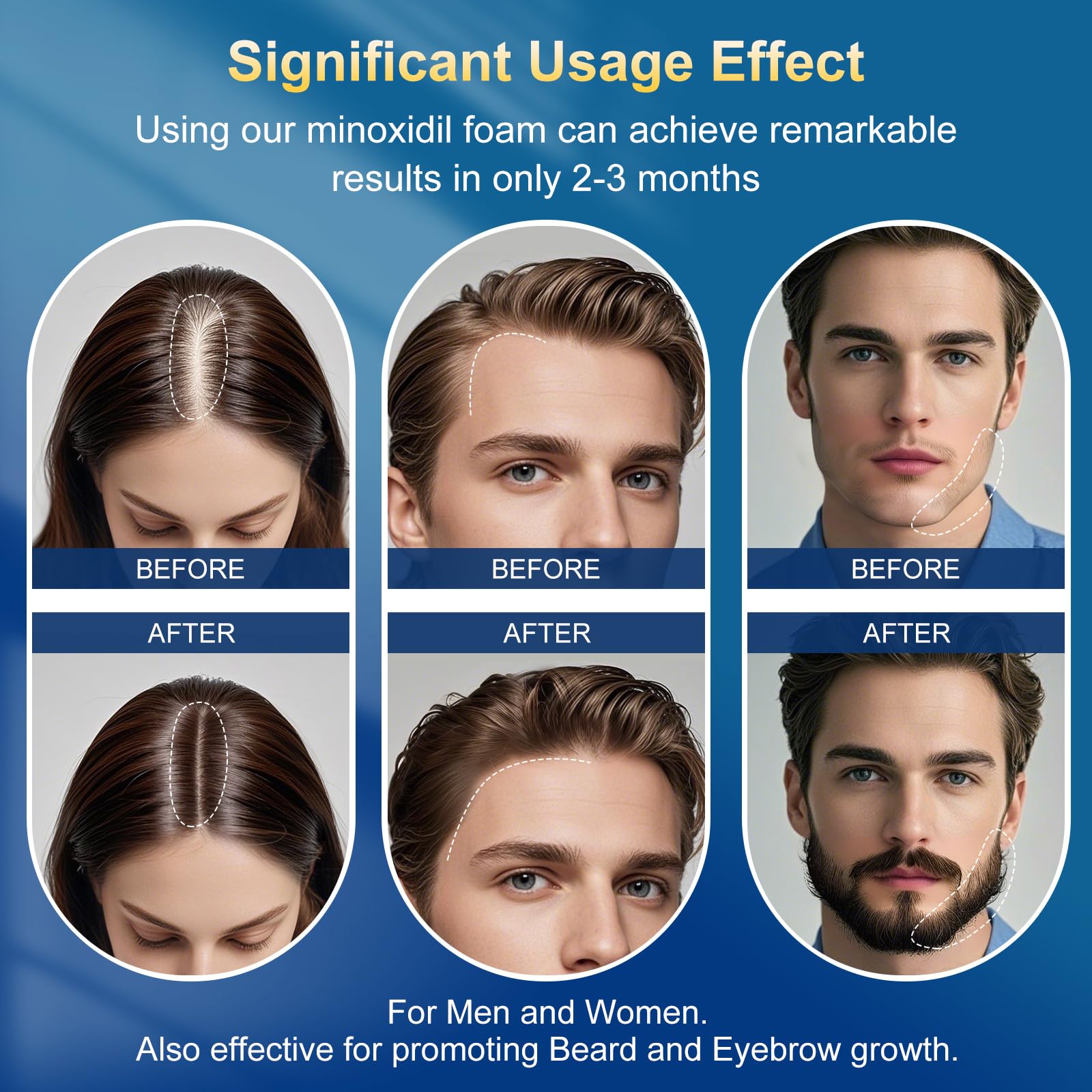 Frnoip 5% Minoxidil Foam for Men – Biotin-Enhanced Hair Regrowth