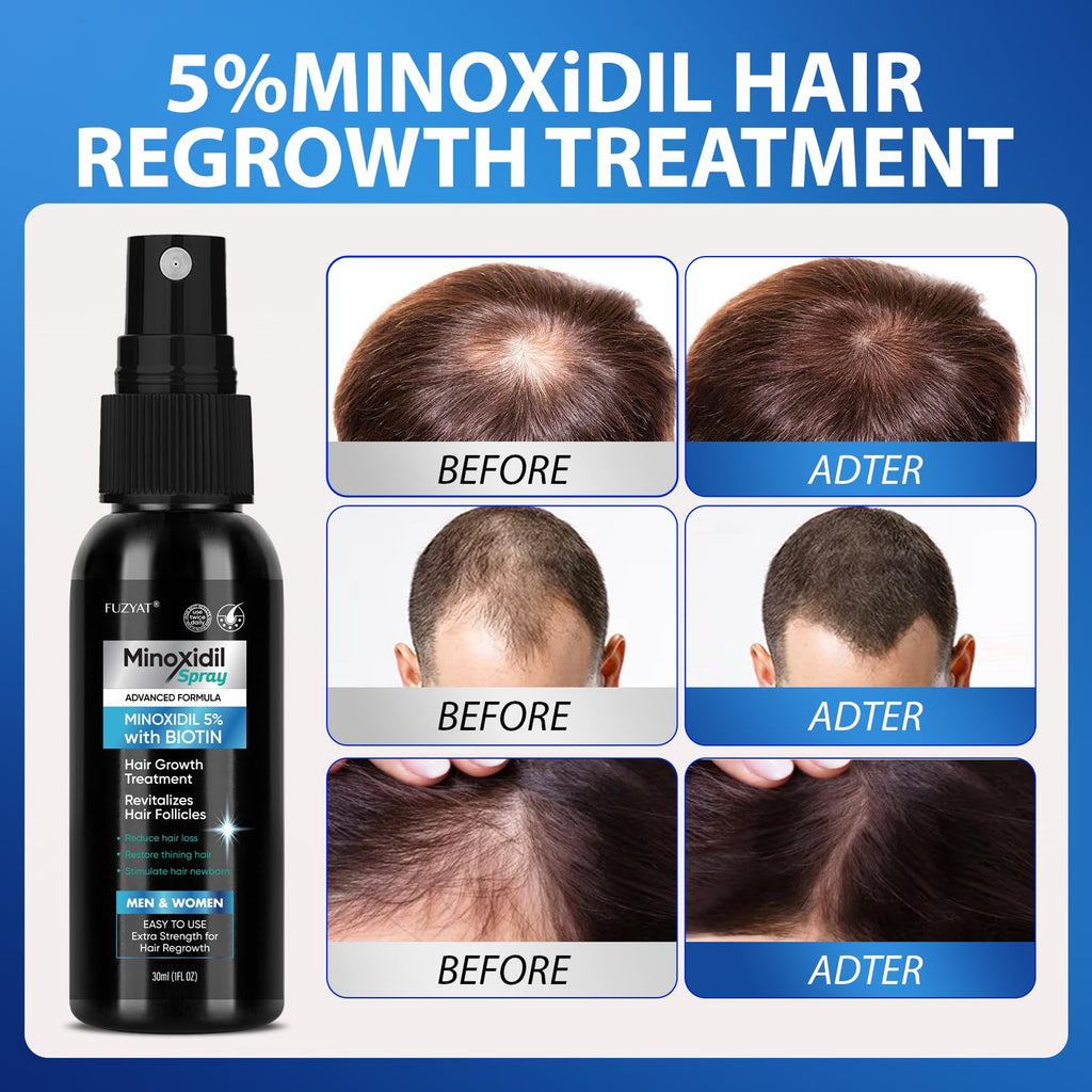 FUZYAT 5% Minoxidil Hair Growth Spray for Men & Women – Biotin, 60ml