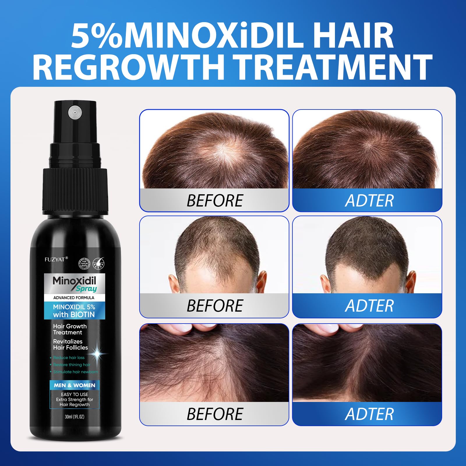 FUZYAT 5% Minoxidil Spray Kit – Hair Growth for Men & Women, 2-Pack