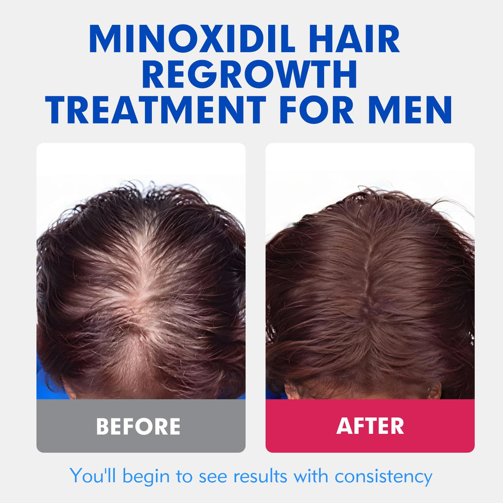 Fyntikal 5% Minoxidil for Men – Hair & Beard Growth, Non-Greasy Topical Solution, 3-Month Supply