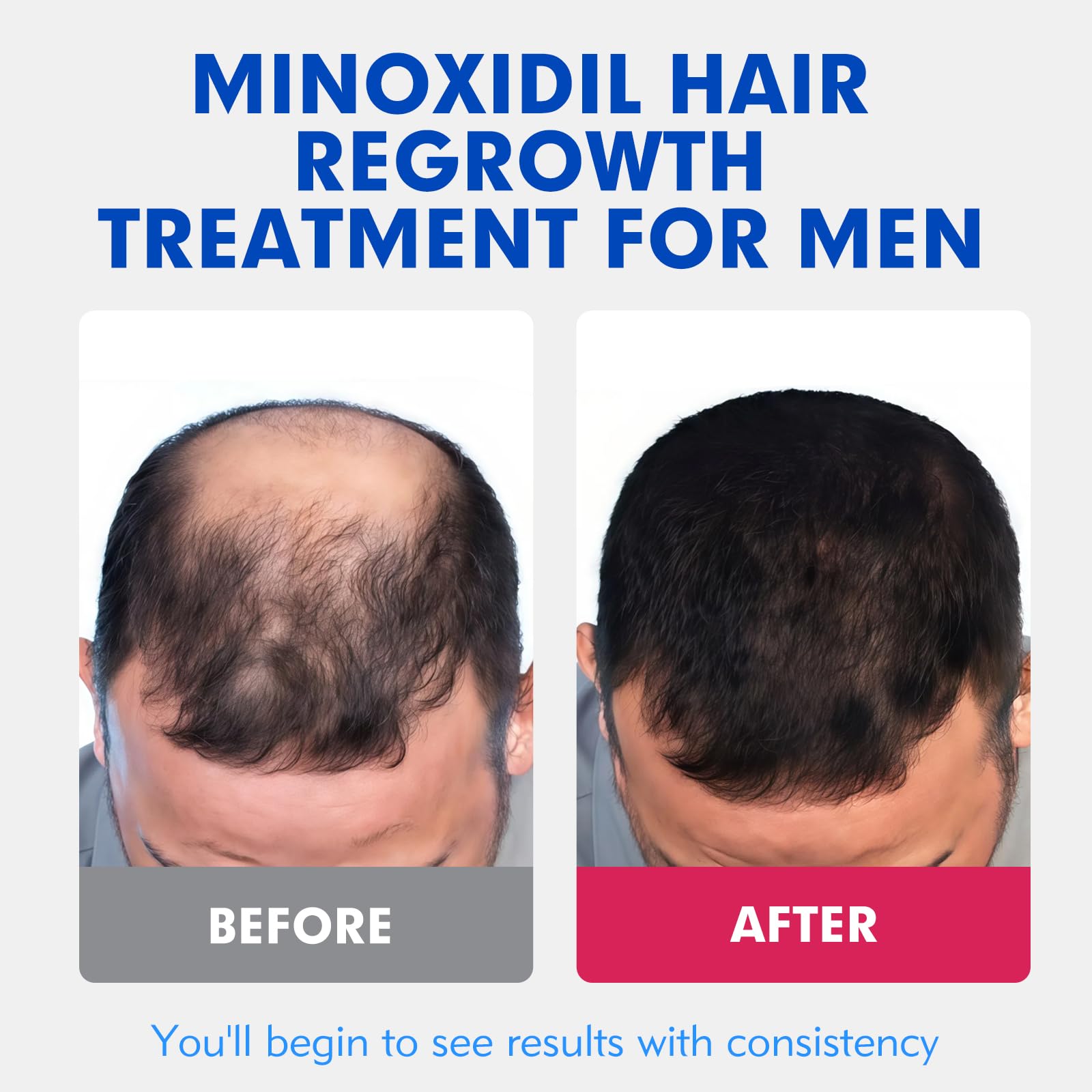 Fyntikal 5% Minoxidil for Men – Hair & Beard Growth, Non-Greasy Topical Solution, 3-Month Supply