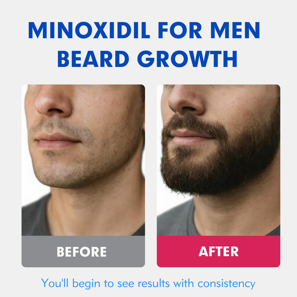 Fyntikal 5% Minoxidil for Men – Hair & Beard Growth, Non-Greasy Topical Solution, 3-Month Supply