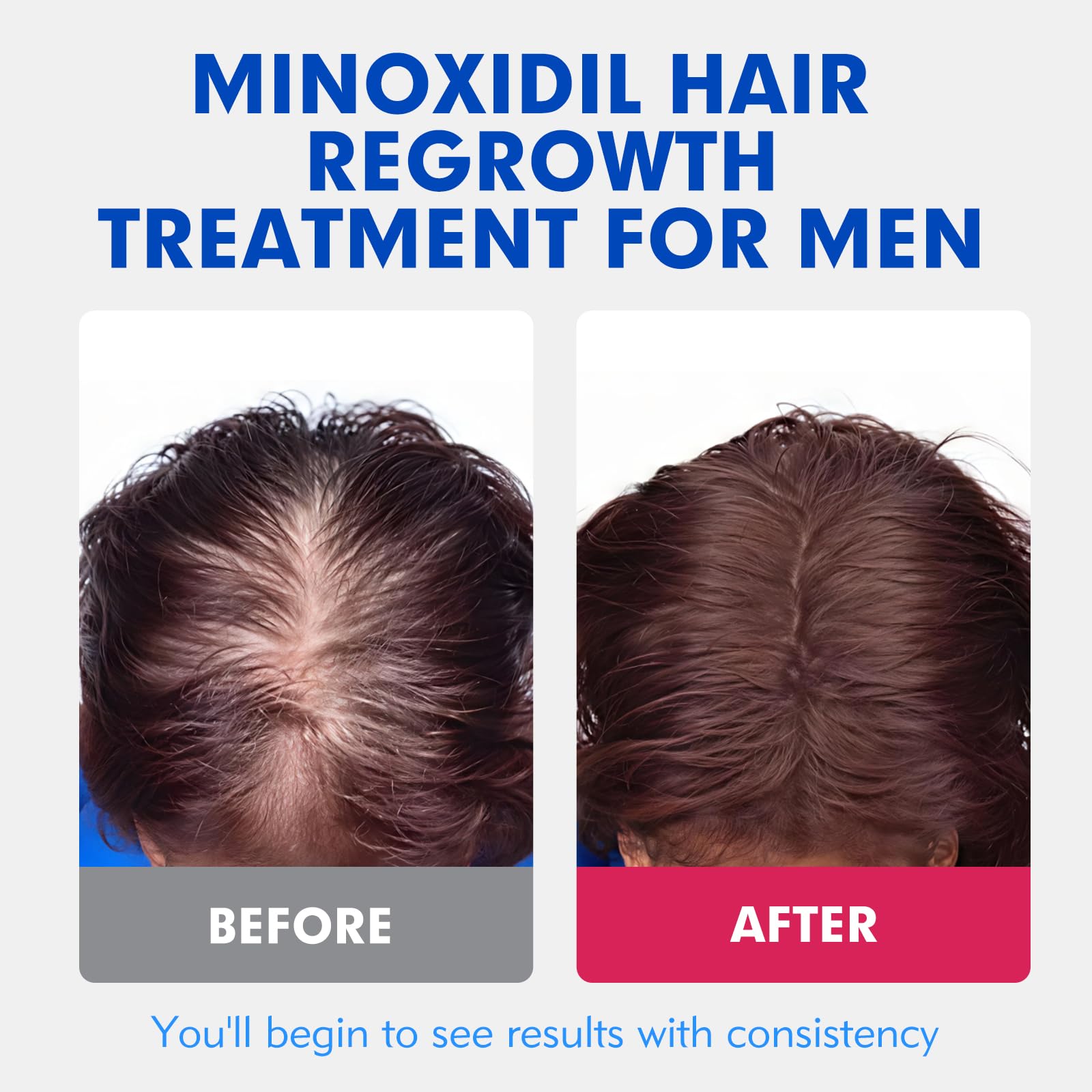 Fyntikal 5% Minoxidil for Men – Extra Strength Hair & Beard Growth Serum (2-Pack)