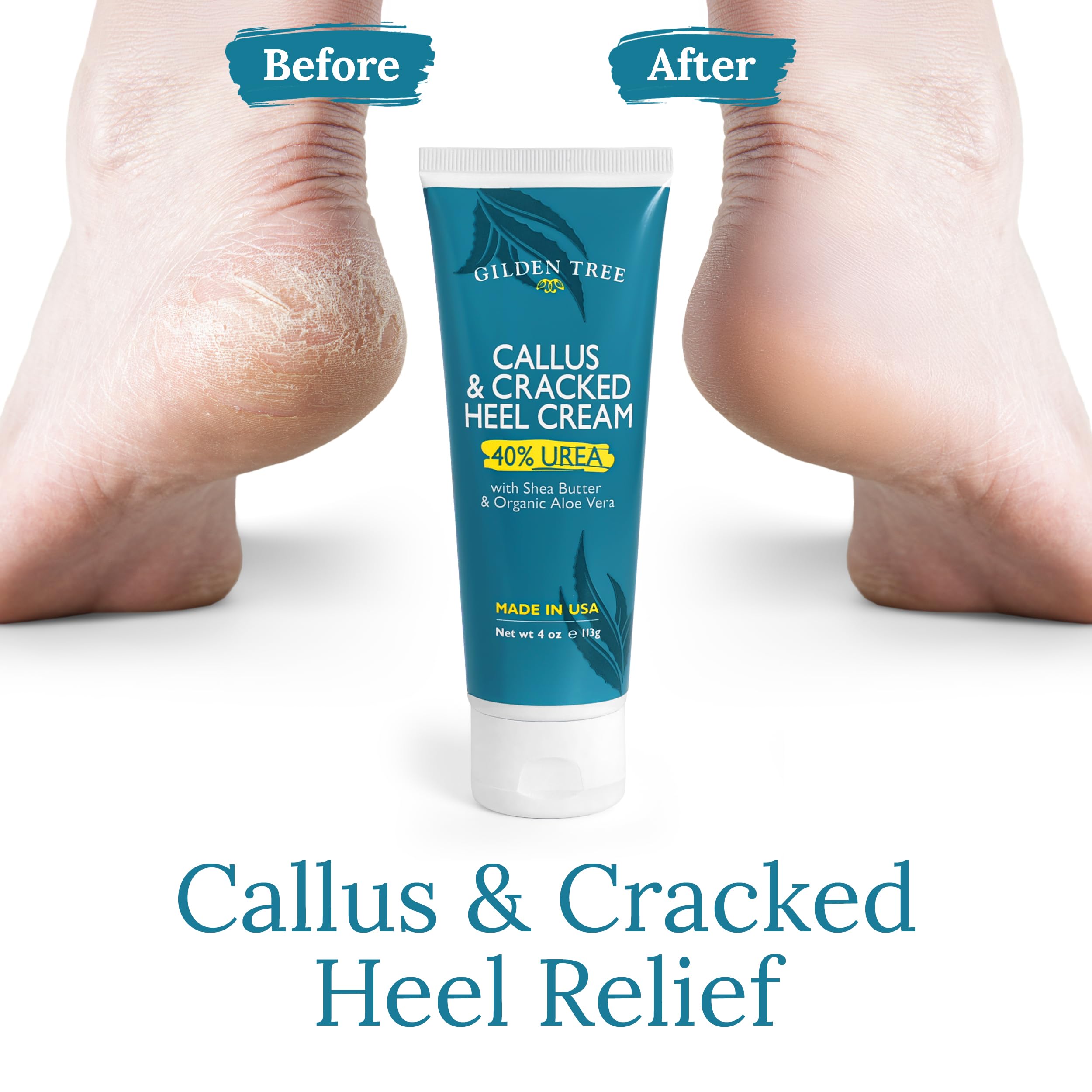 GILDEN TREE Urea Cream 40% for Feet | Maximum Strength Cracked Heel Treatment
