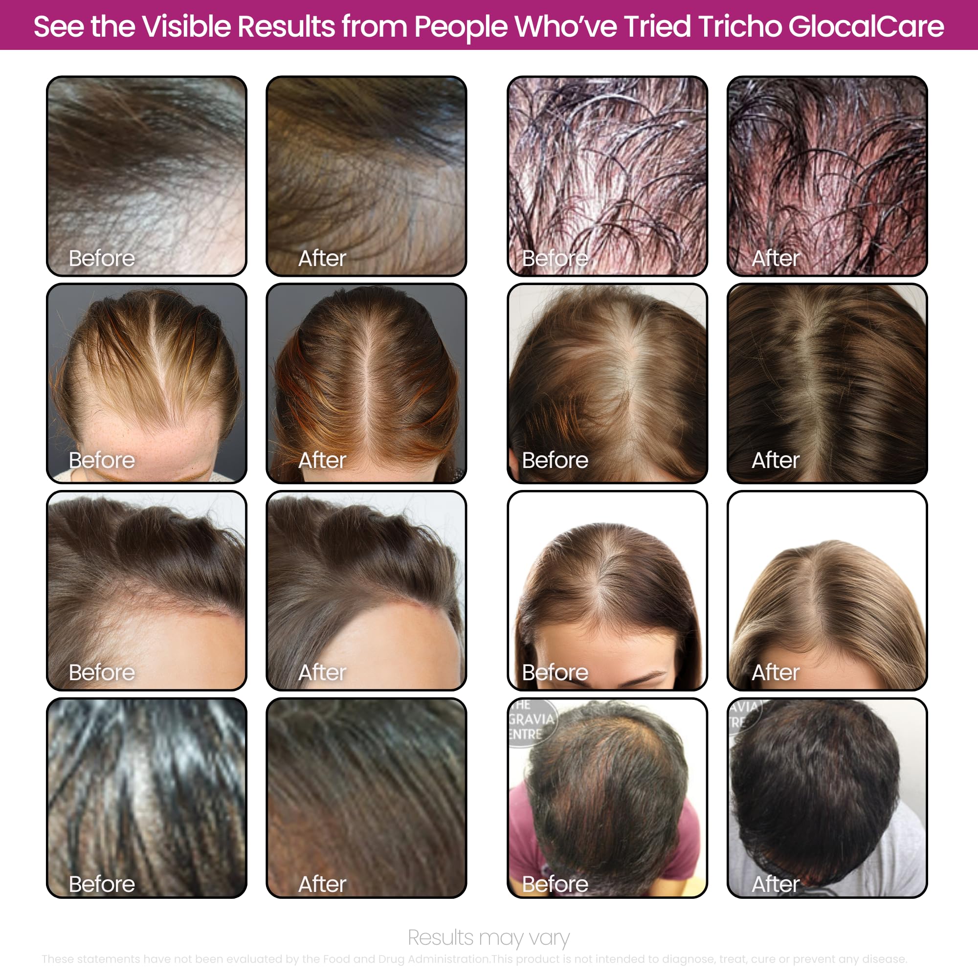 GlocalCare Tricho – Hair Growth Supplement with Saw Palmetto & Biotin 5000mcg