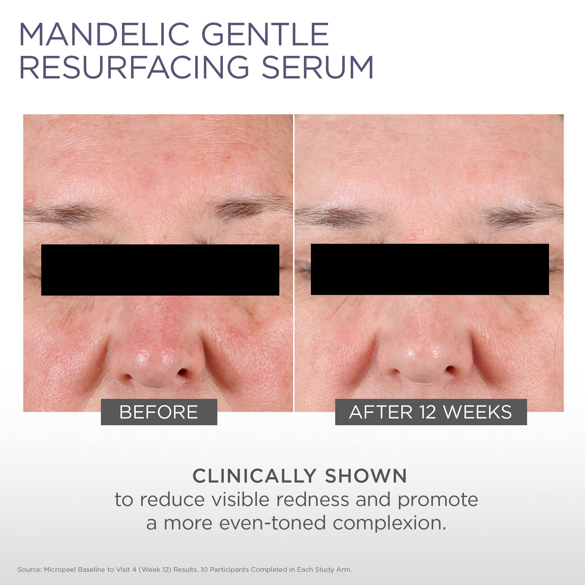 GLYTONE Micro-Peel Mandelic Serum 10% | Gentle AHA Exfoliant for All Skin Types