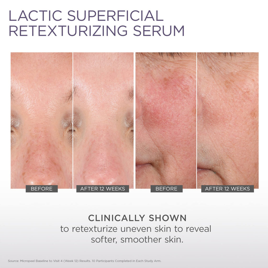 Glytone Micro-Peel Lactic Superficial Retexturizing Serum | 10% Lactic Acid Exfoliant for Face & Neck | Hydrates, Brightens & Reveals Smoother Skin | Paraben-Free - 1 Fl oz
