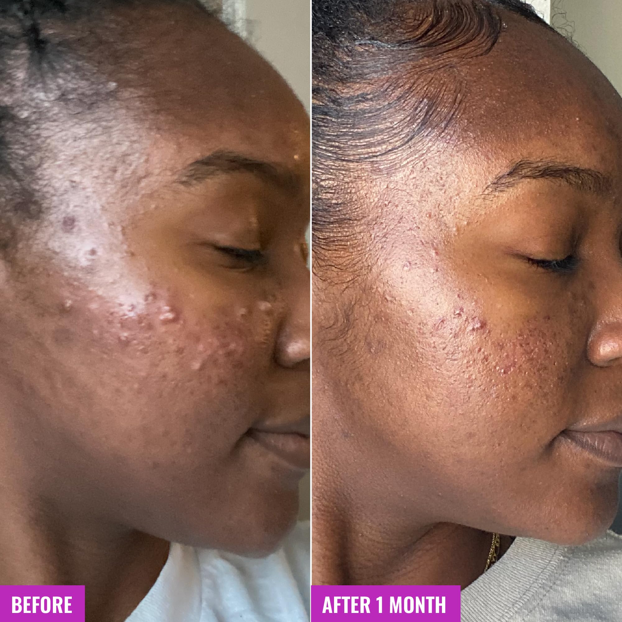 Good Molecules Acne Foaming Cleanser – 2% Salicylic Acid Foam Cleanser for Clearer Skin