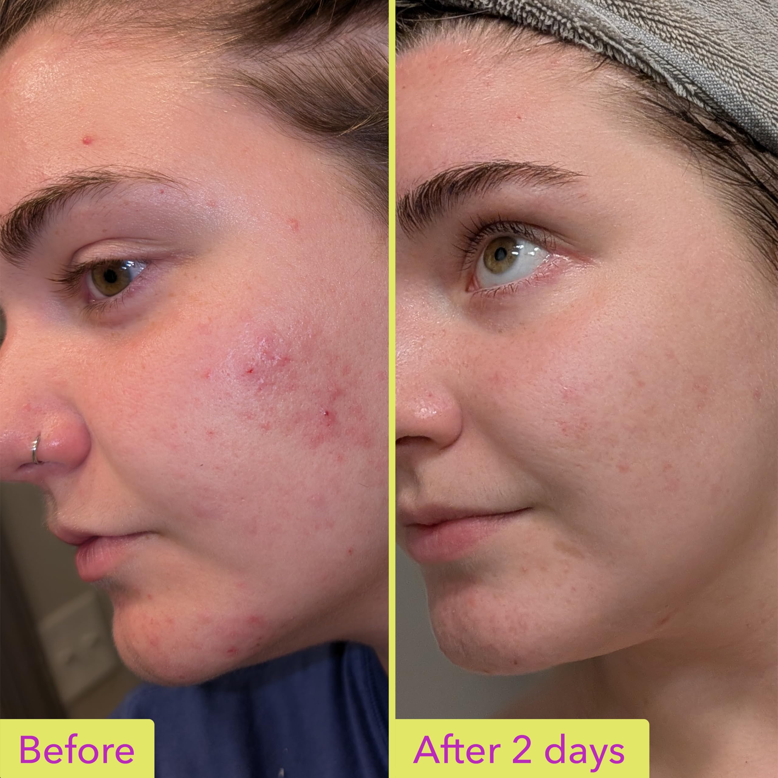 Good Molecules 10% Azelaic Acid Treatment – Fragrance-Free, Vegan for Redness & Uneven Tone