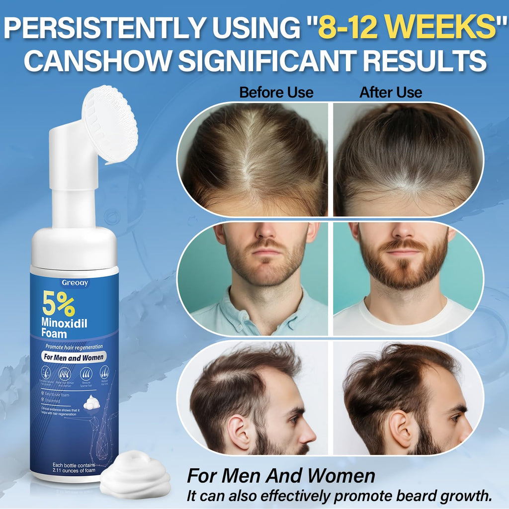 Greoay 5% Minoxidil Hair Growth Foam for Men & Women – Thinning Hair & Receding Hairline