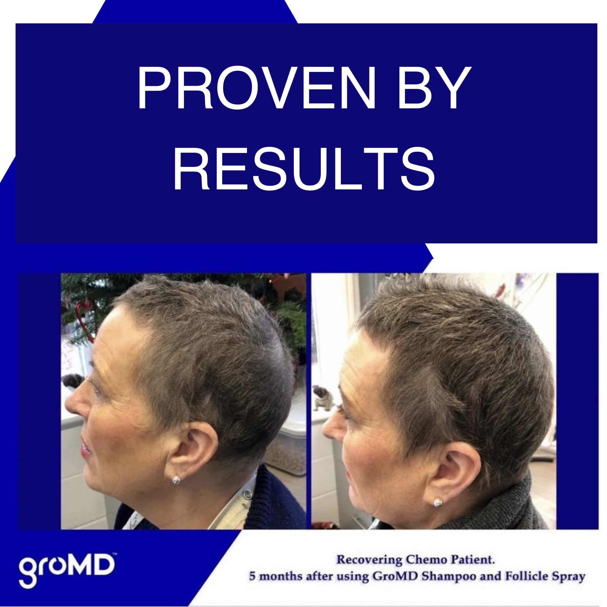 GroMD Hair Loss Serum — Doctor-Developed Hair Growth Treatment with DHT Blocking, Argan Oil & Caffeine | 60 Day Supply