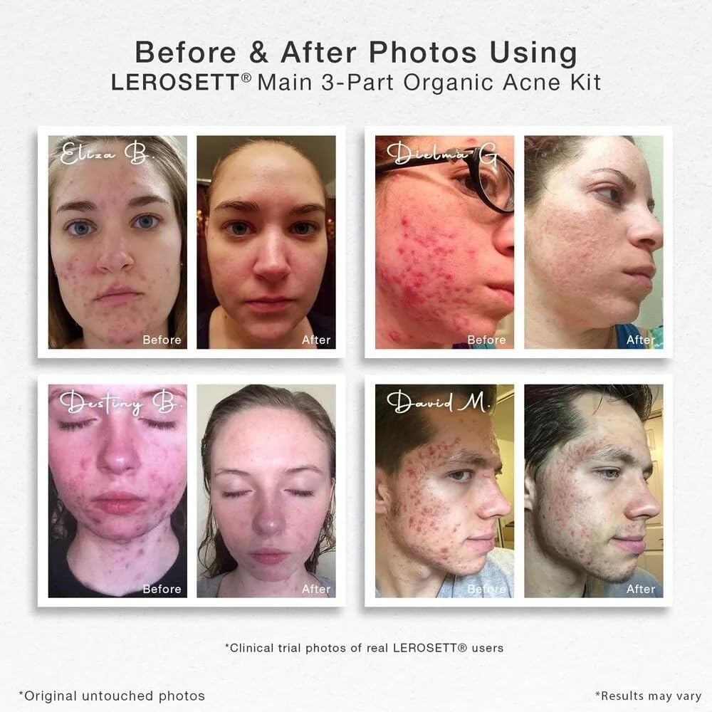 LEROSETT Acne Kit by Gunilla Of Sweden – Aloe & Clay Based, Vegan, All Skin Types