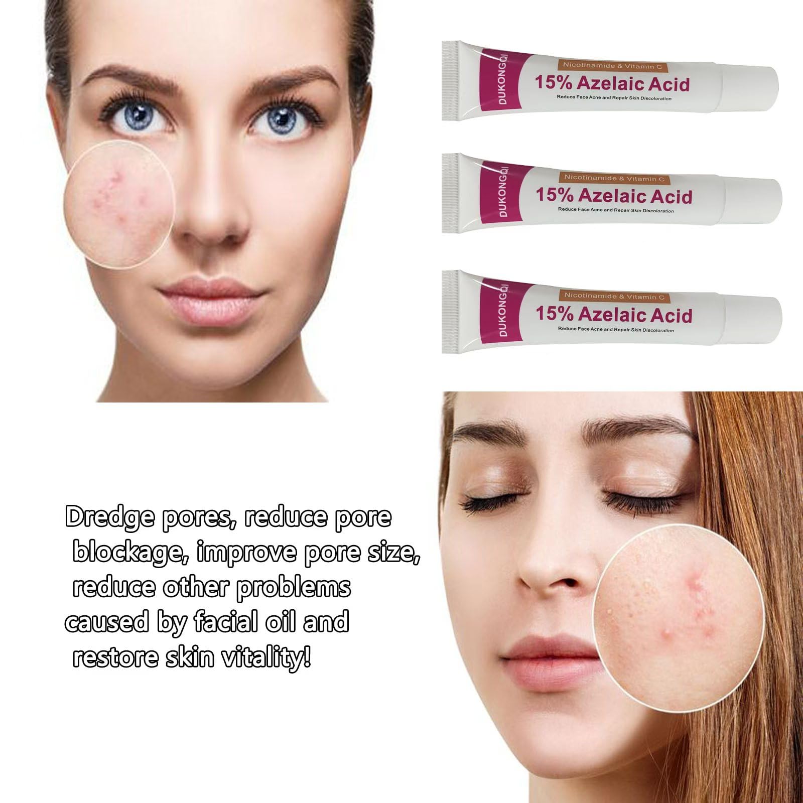 gzchaox Azelaic Acid Cream – 15% Facial Care Essence, 20g for Acne and Redness