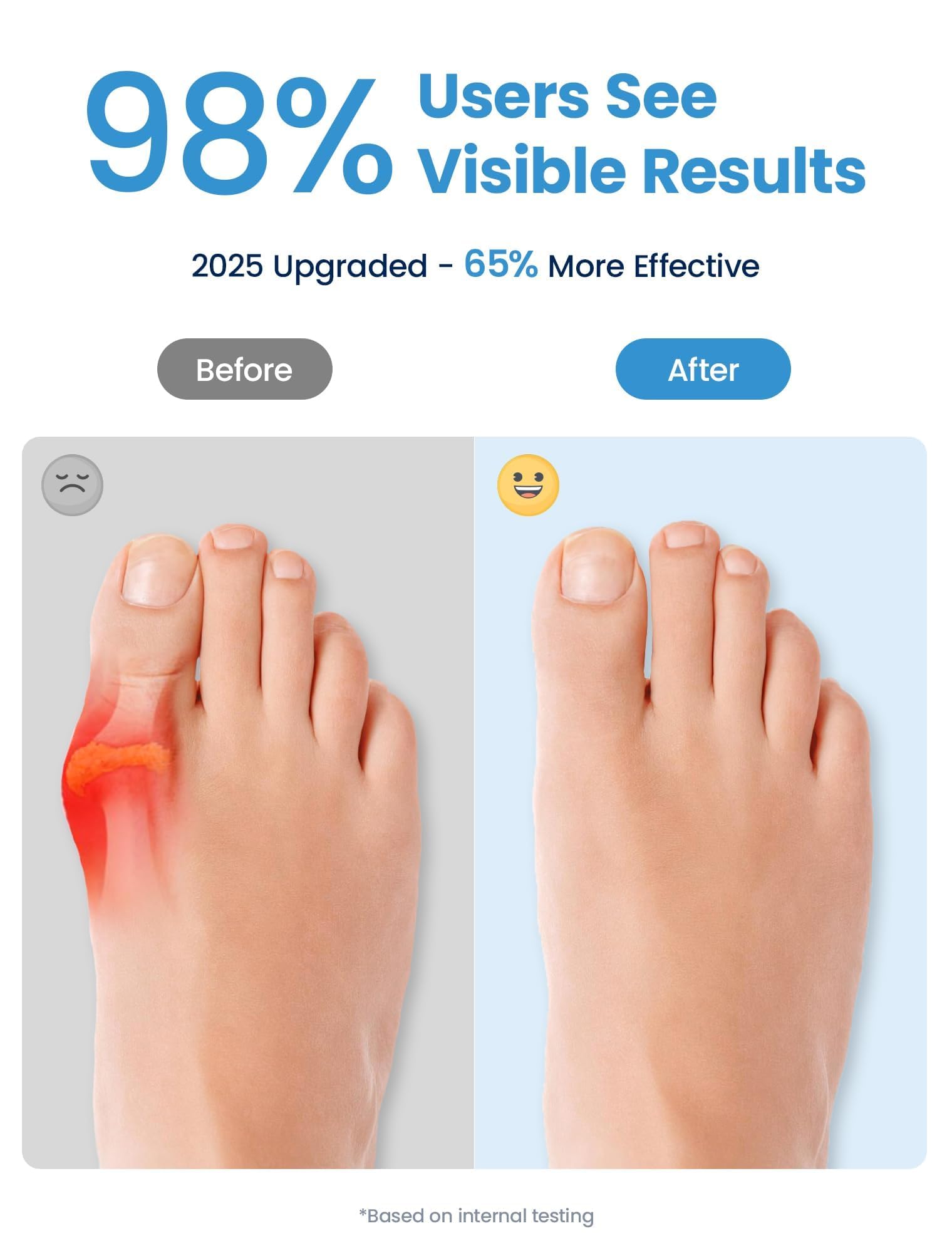 Habioer Bunion Corrector & Toe Spacers – Gentle Alignment for Everyday Comfort