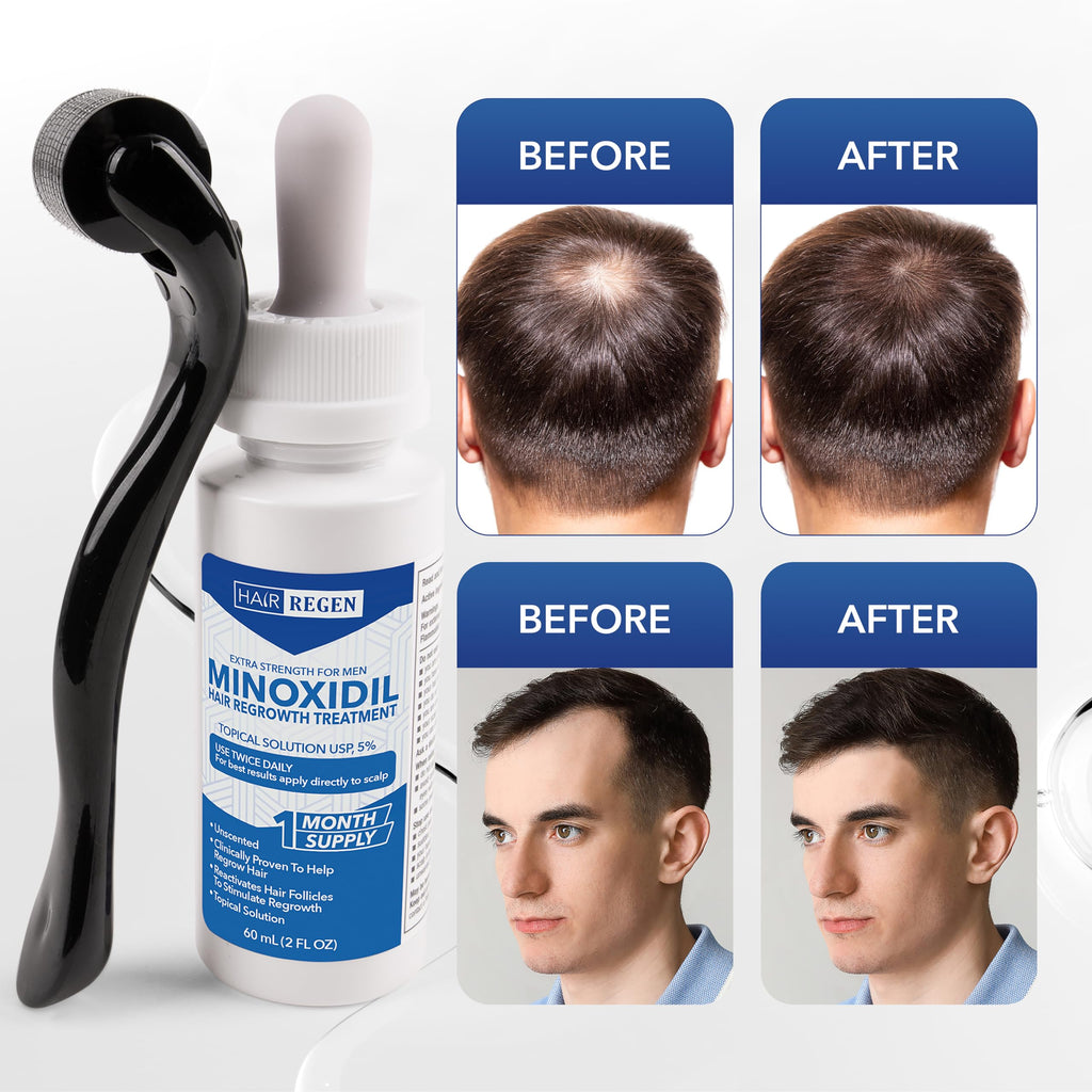 Hair Regen Minoxidil 5% + 0.25mm Derma Roller – 6-Month Supply for Men