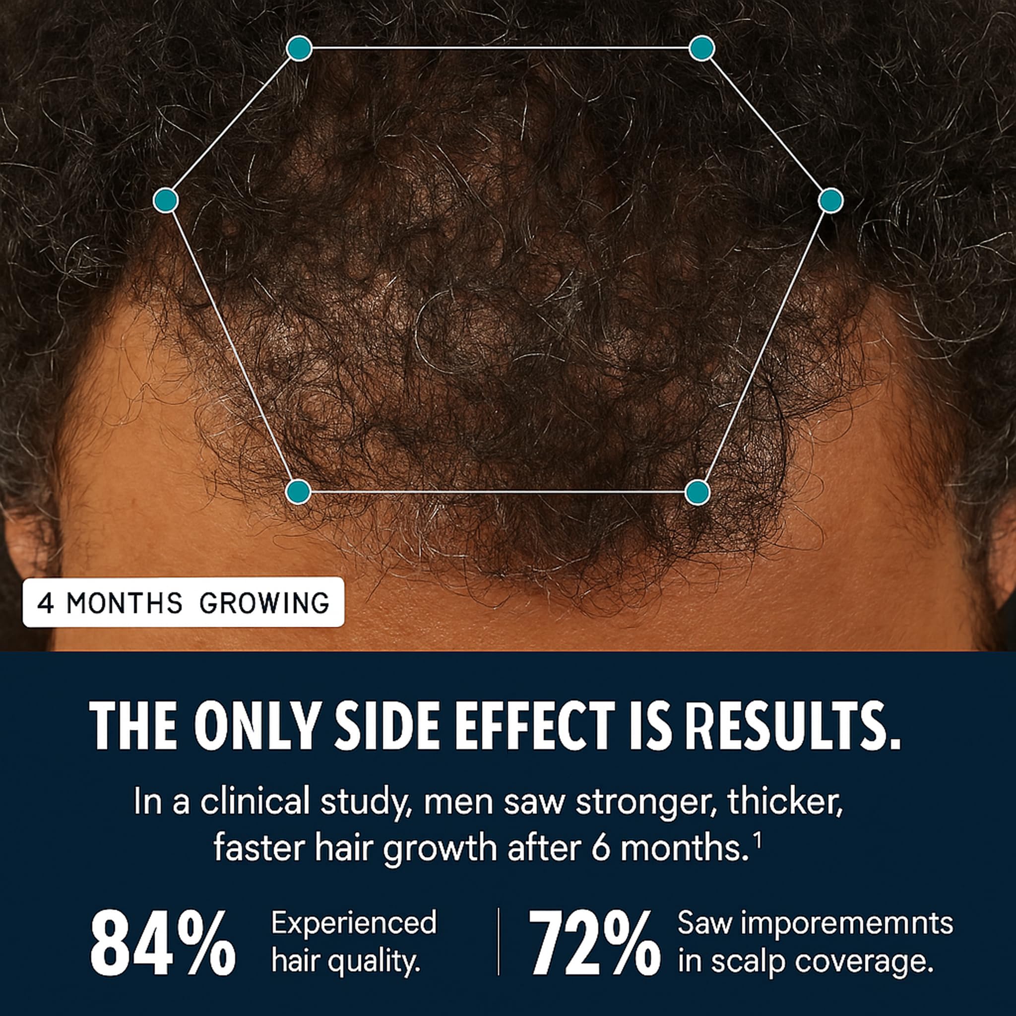 Hairfol Men's Hair Growth Supplement – Thicker Hair, Fuller Scalp Coverage – 1 Month Supply