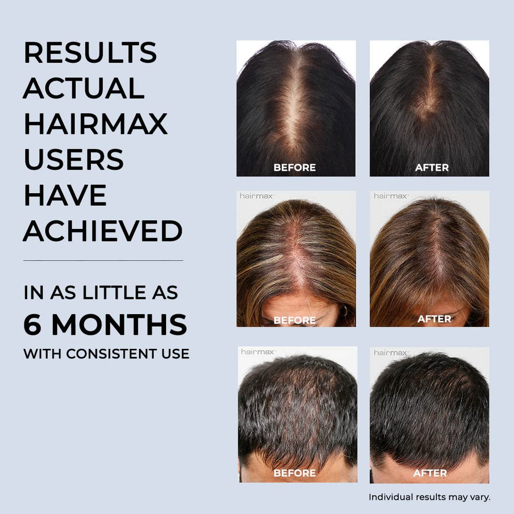 HairMax Laser Band 41 – FDA-Cleared Red Light Therapy Device for At-Home Hair Growth