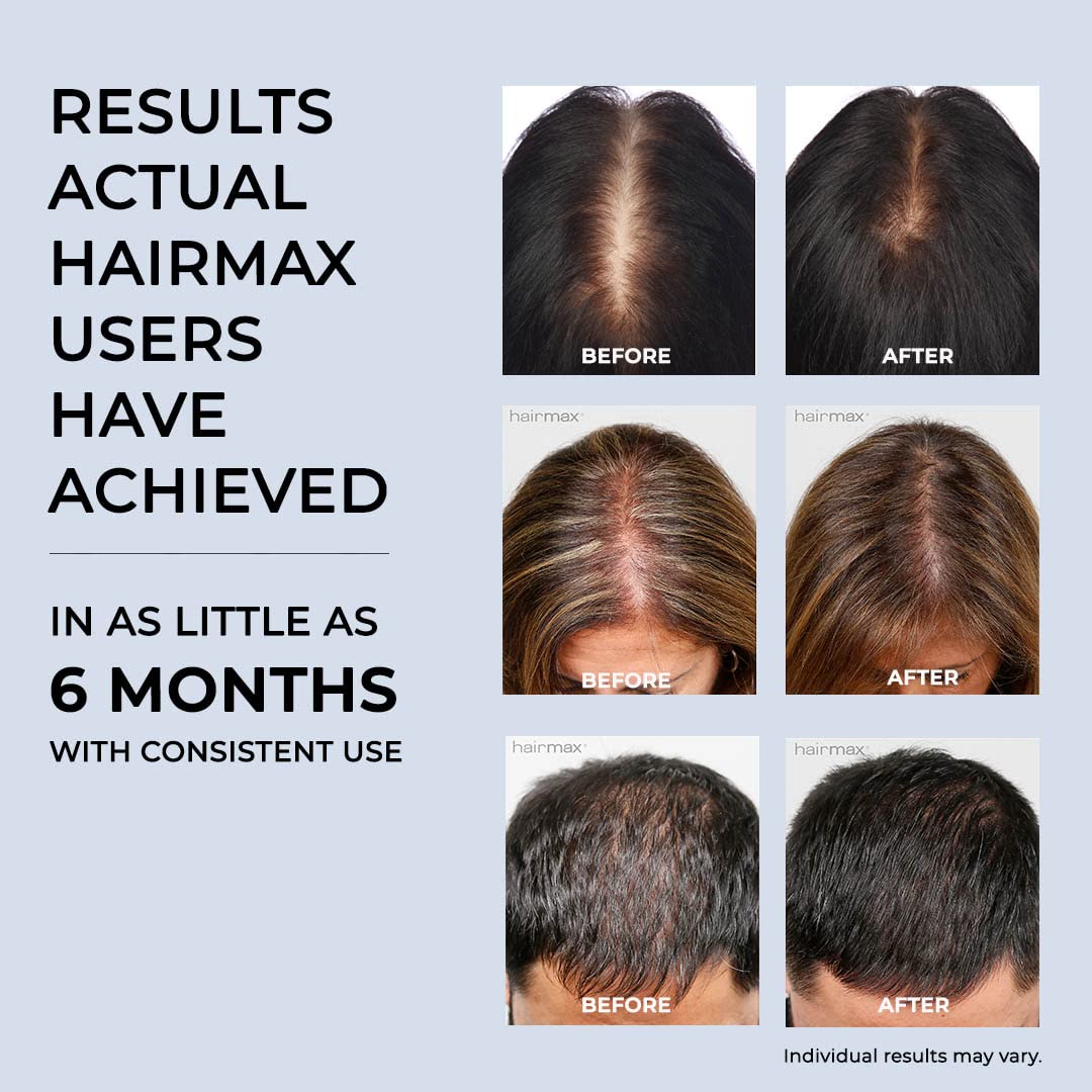 HairMax Laser Band 41 – FDA-Cleared Red Light Therapy Device for At-Home Hair Growth