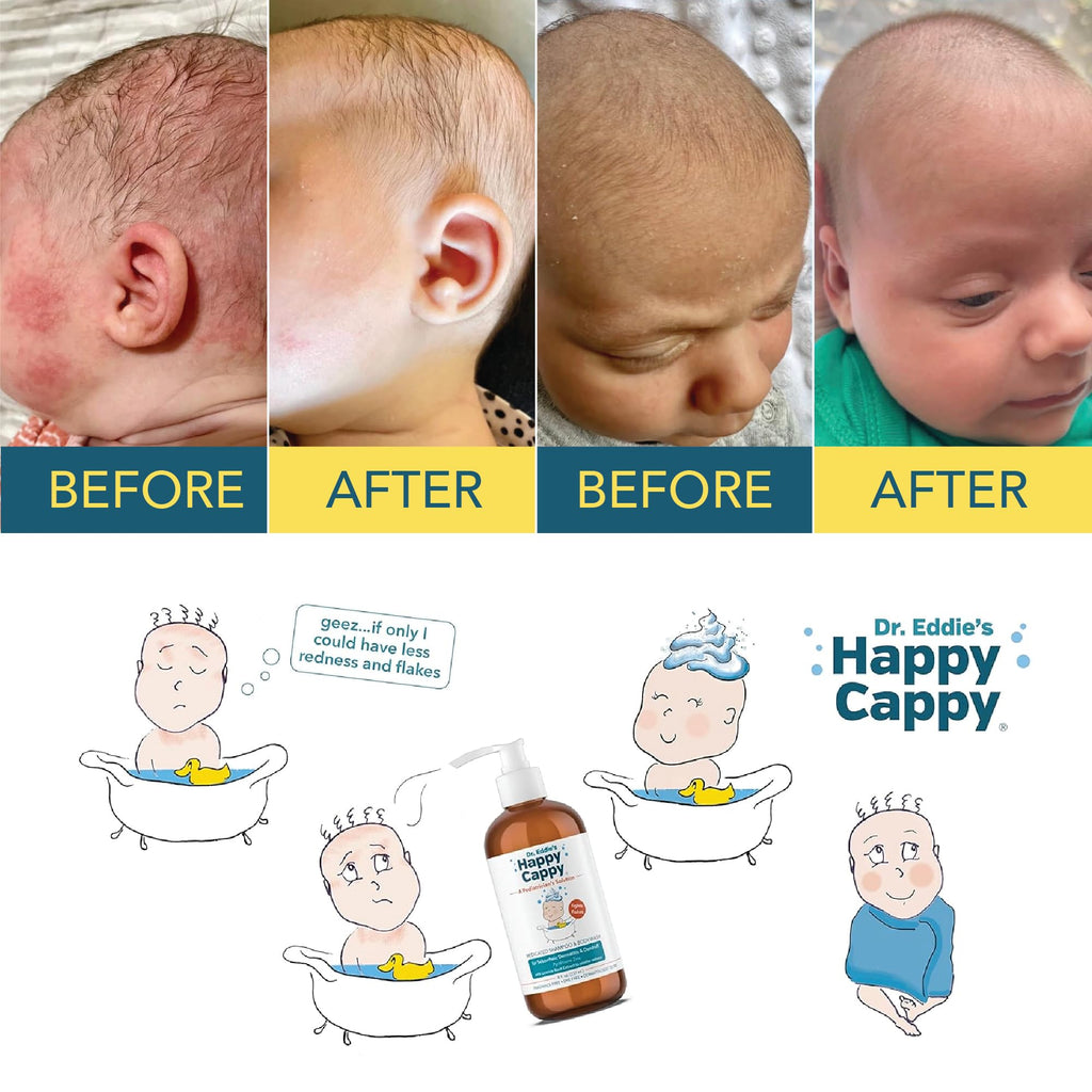 Happy Cappy Medicated Shampoo & Body Wash – Fragrance-Free for Cradle Cap & Dandruff (4 x 8 oz)