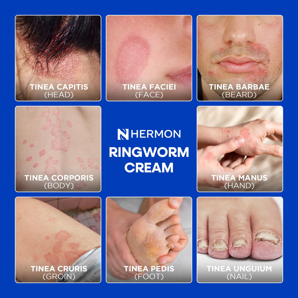 Hermon Antifungal Cleansing Soap – Ringworm Care (Tea Tree & Sulfur) 2-Pack