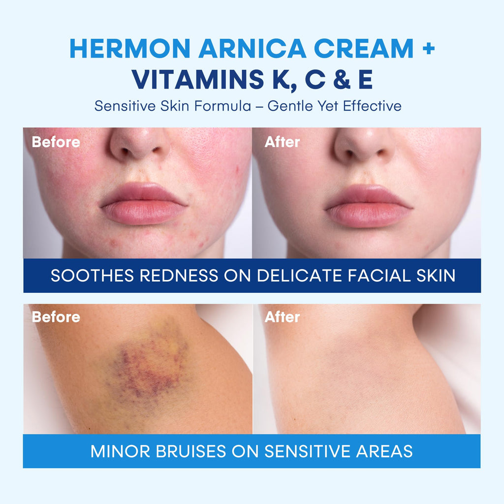 Hermon Arnica Bruise Cream with Vitamin K – Sensitive Skin & Face Formula, Extra Strength Hydrating Moisturizer 2 Oz