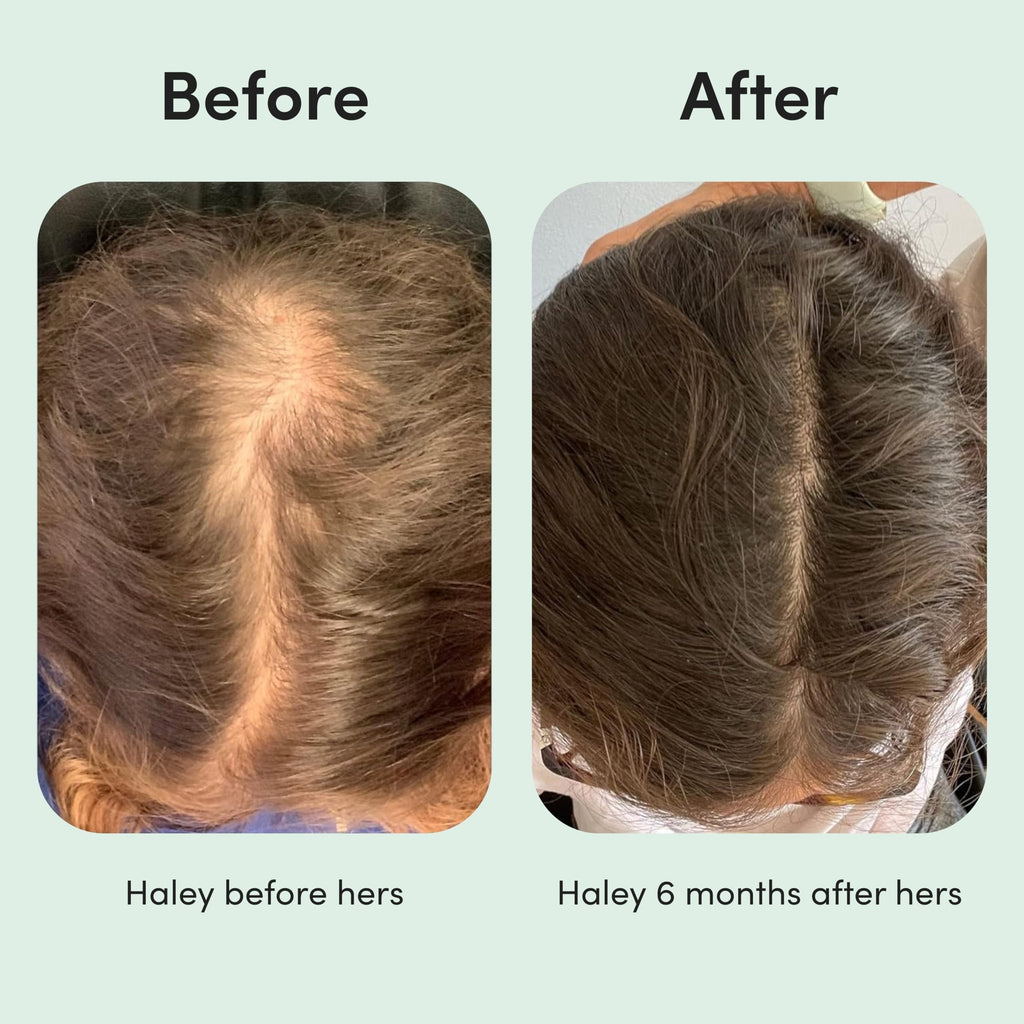 hers Hair Regrowth Treatment 2% Minoxidil for Women – Fuller, Non-Greasy (2-Pack)