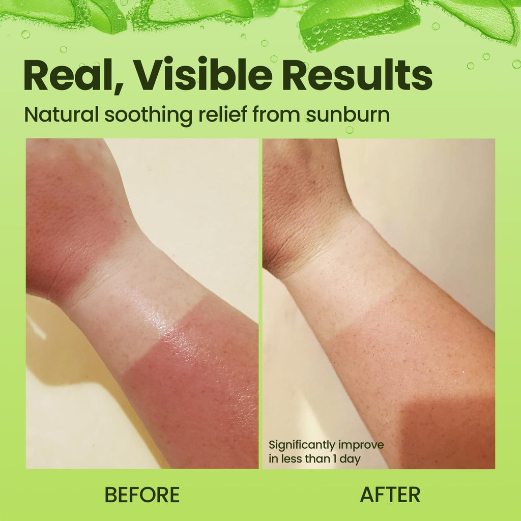 Honeyskin Organic Aloe Vera Gel – 100% Pure, Sunburn Relief & Face Moisturizer (64 fl oz)