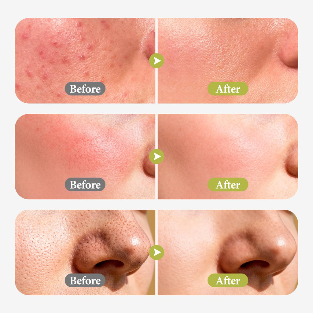 Hyuxeo Salicylic Acid Serum – Acne & Pore Minimizing | Glycolic + Witch Hazel