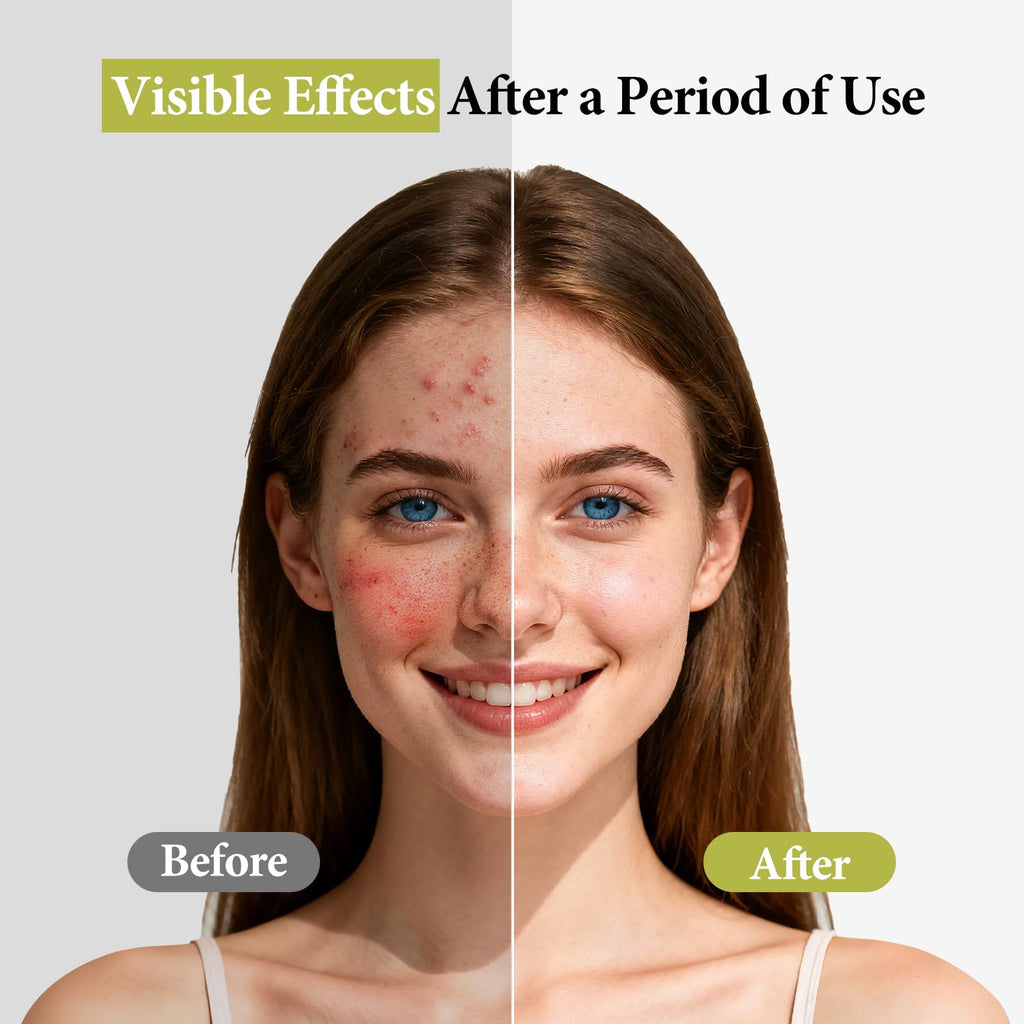 Hyuxeo Salicylic Acid Serum – Acne & Pore Minimizing | Glycolic + Witch Hazel