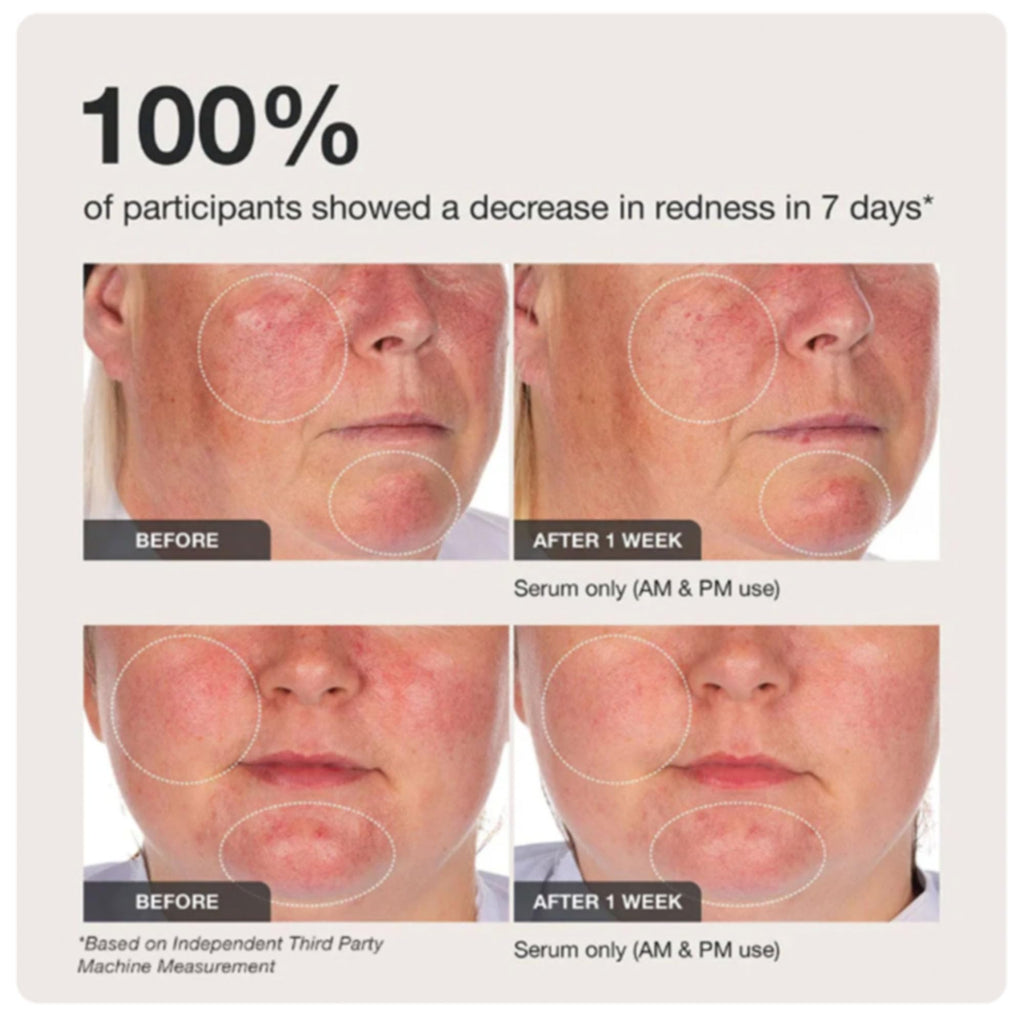 Innbeauty Project Calm the Red Down Dual Chamber Serum – Redness Relief & Barrier Support | 1.7 oz