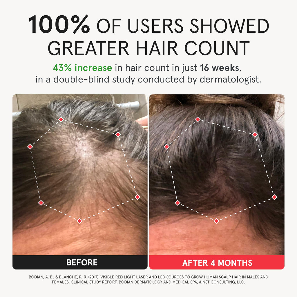 iRestore Elite Laser Hair Growth System – FDA-Cleared Home Treatment with 500 Lasers & LEDs