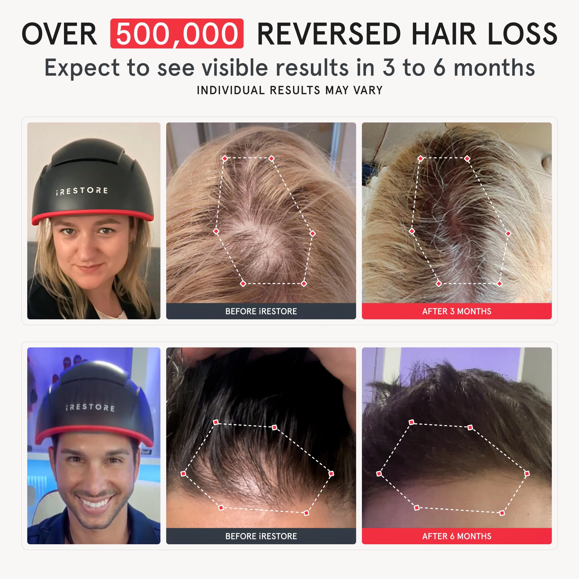iRestore Elite Laser Hair Growth System – FDA-Cleared Home Treatment with 500 Lasers & LEDs