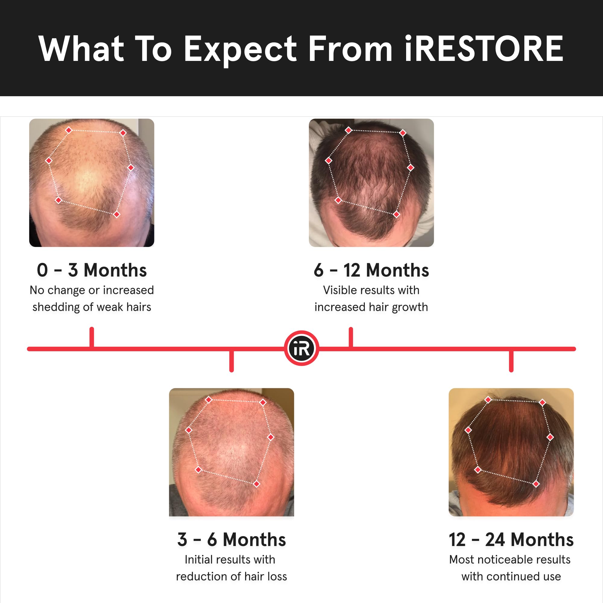 iRestore Essential Laser Hair Growth System – FDA-Cleared Hair Loss & Thinning Treatment for Men & Women