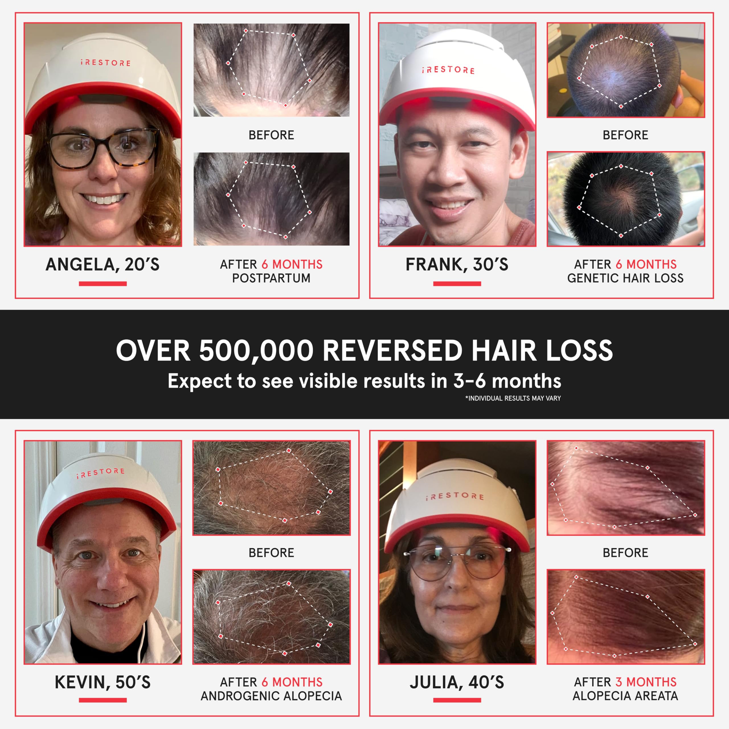 iRestore Pro: 282 Lasers & LEDs Hair Growth System | FDA Cleared