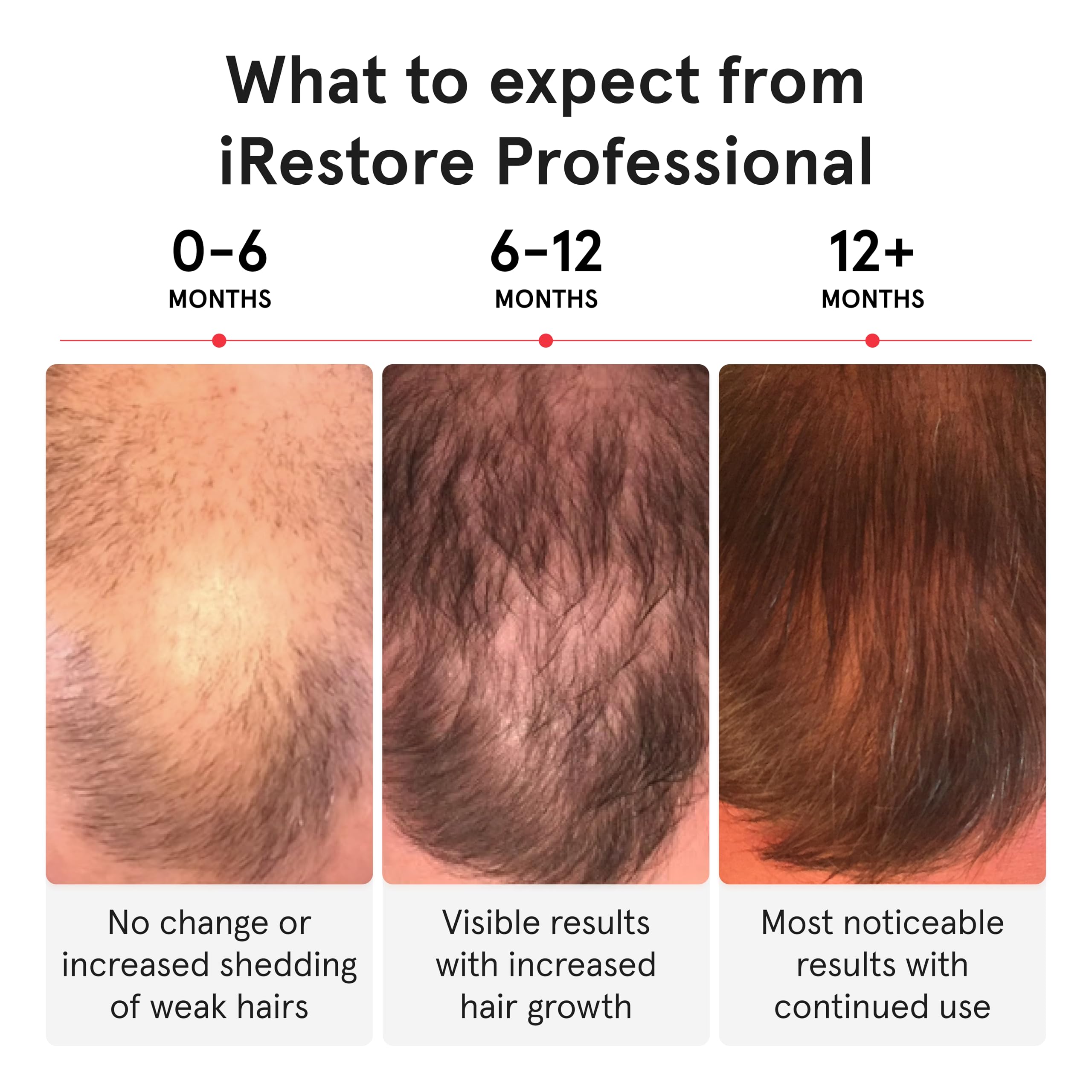 iRestore Pro: 282 Lasers & LEDs Hair Growth System | FDA Cleared