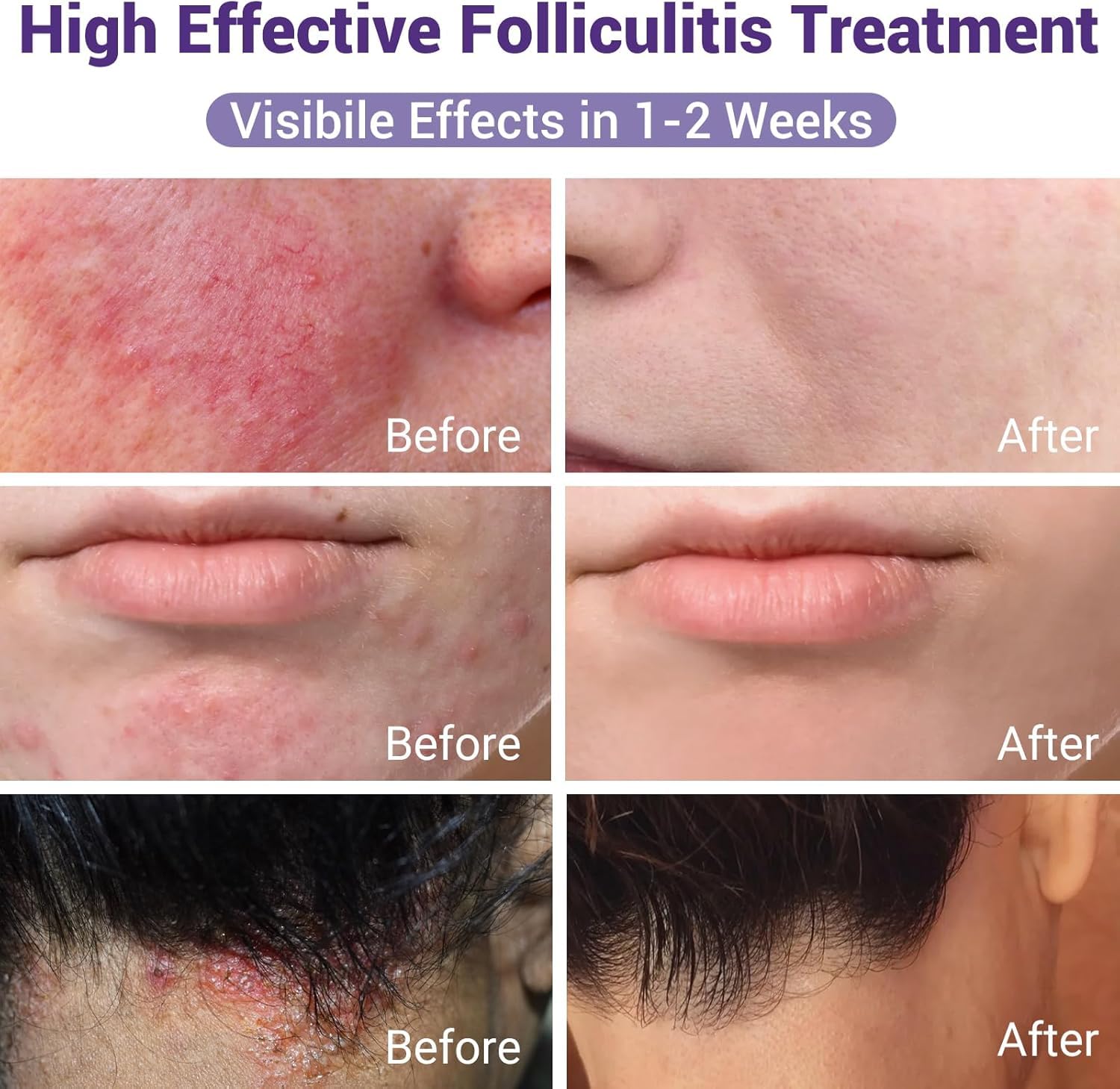 ishancare Folliculitis Treatment Cream – Natural Relief for Itching, Redness & Inflammation | 3.53 Oz