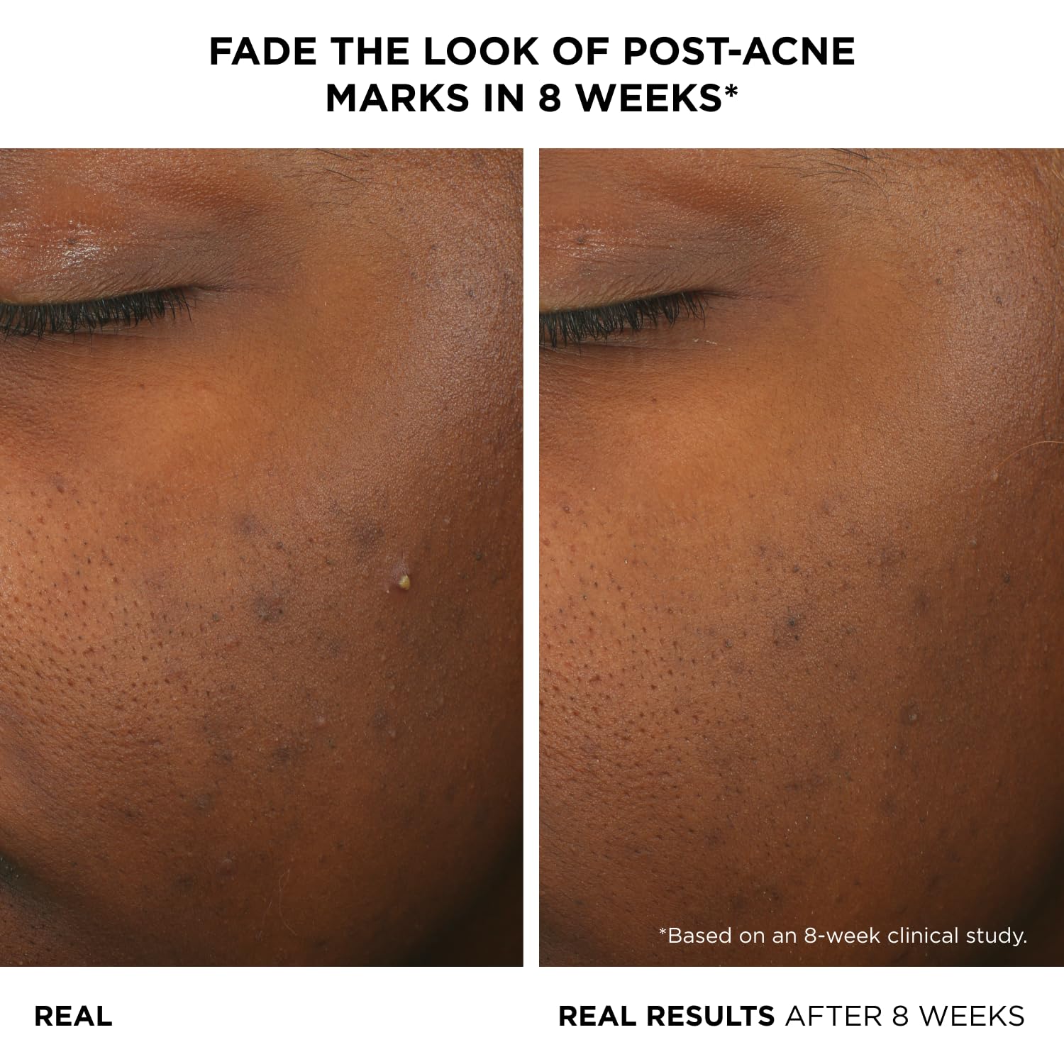 IT Cosmetics Bye Bye Breakout Acne Serum — 2% Salicylic + 3% Lactic Acid