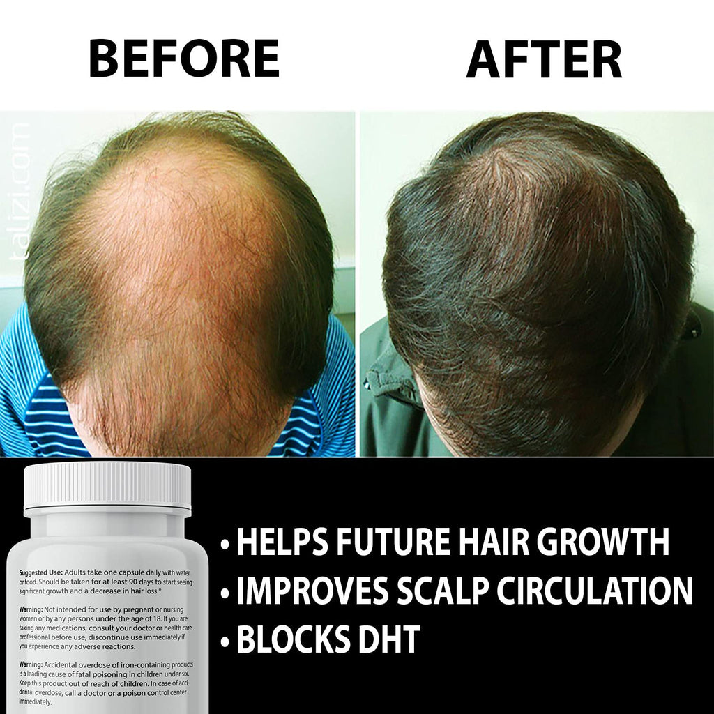 Finanutride | Natural DHT Blocker & Hair Growth Capsules | IXYAY RESEARCH