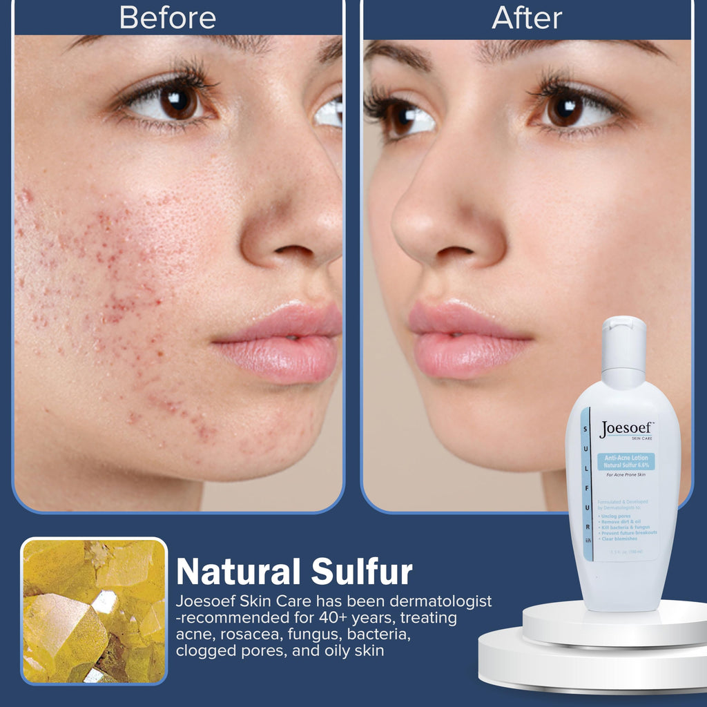 JOESOEF SKIN CARE Anti-Acne Lotion 6.6% Sulfur – Dermatologist-Approved Acne Care for Prone Skin | 100ML