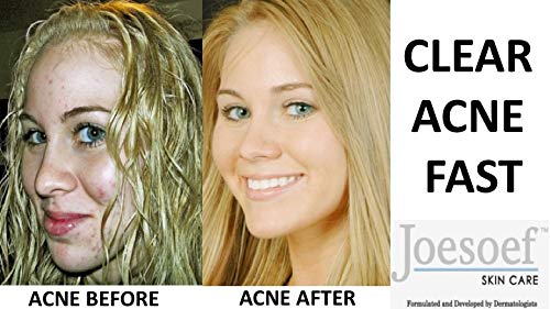 JOESOEF SKIN CARE Sulfur Soap Acne Facial Cleanser 4-Pack